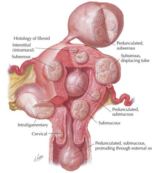 fibroids netter