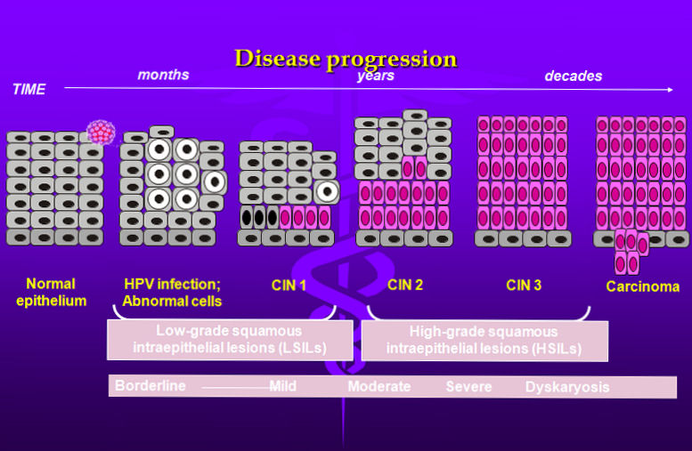 hpv disease progression