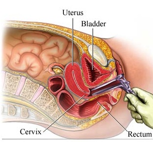 vaginal speculum examination diagram